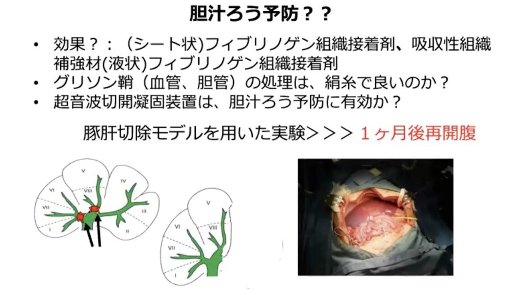 2022.3.9 BD East Japan HBP Surgery Lecture 画像5